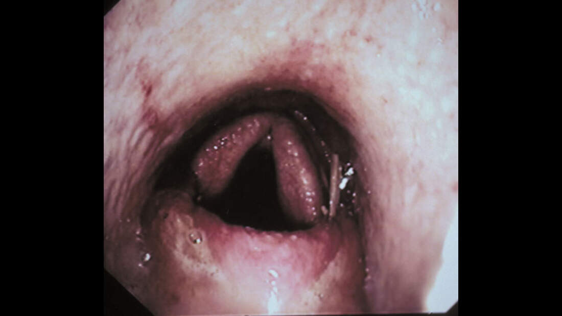 CAV Symptom-Lexikon - Gaumensegelverlagerung